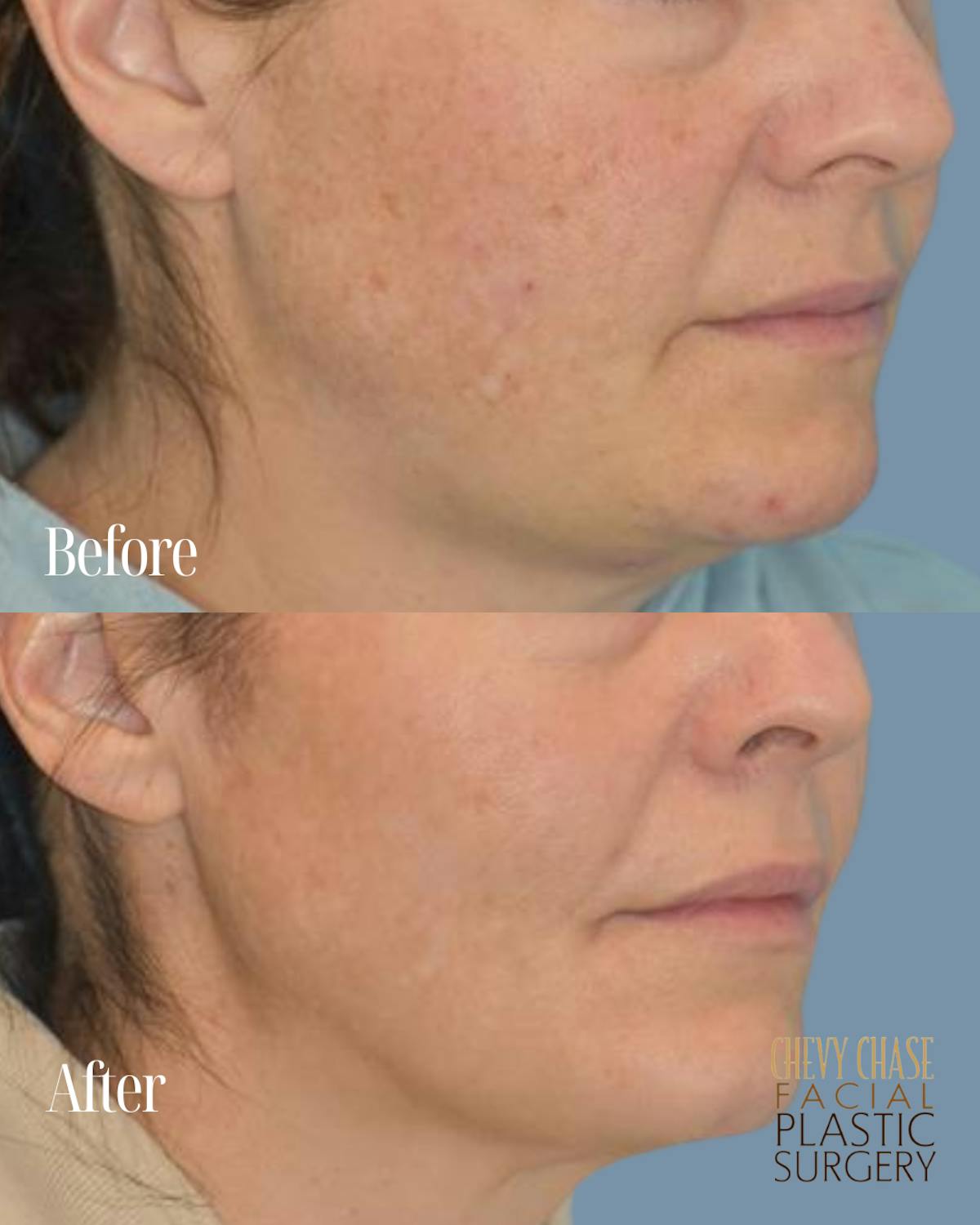 Broadband Light (BBL) Before & After Gallery - Patient 627115 - Image 2