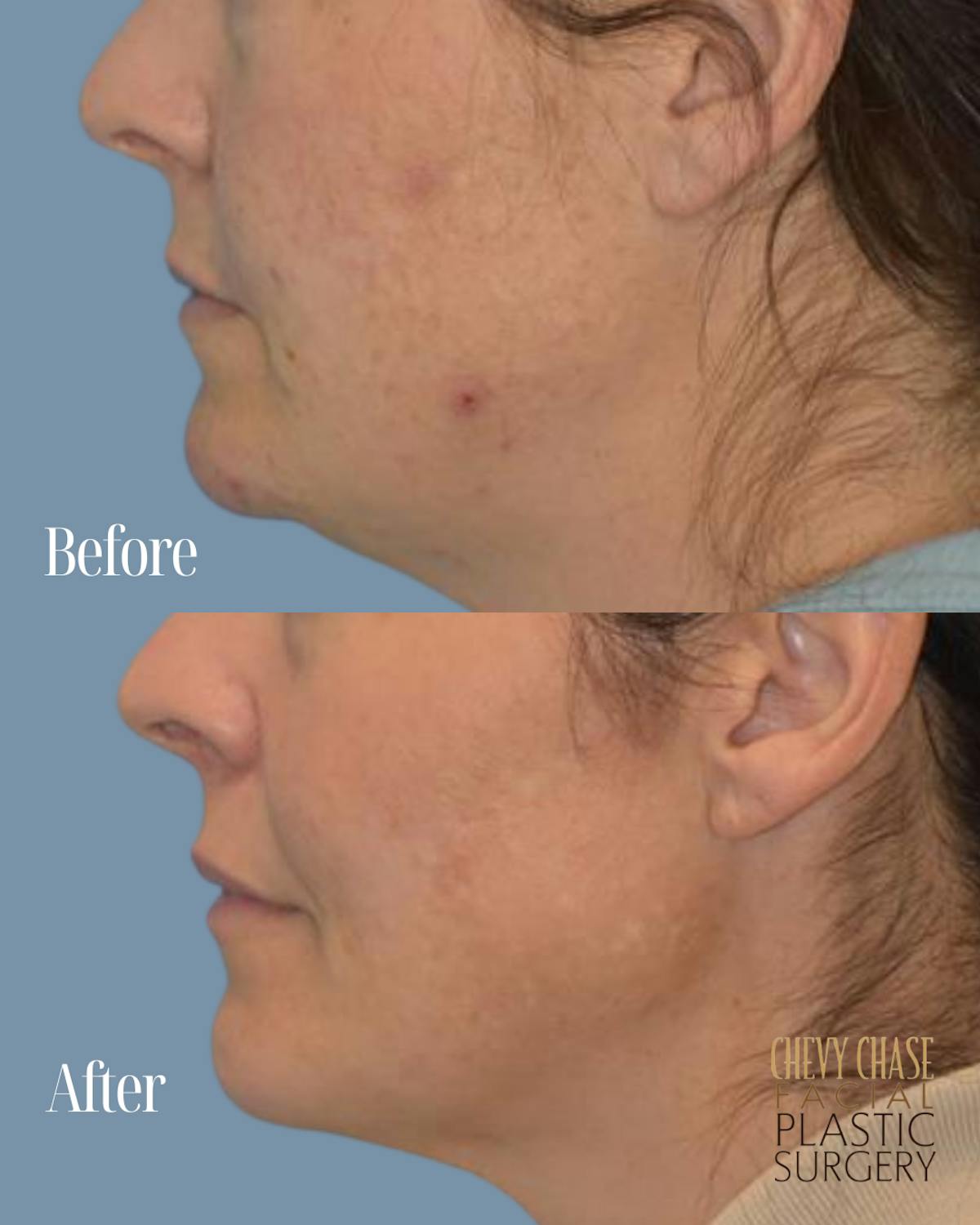Broadband Light (BBL) Before & After Gallery - Patient 627115 - Image 5