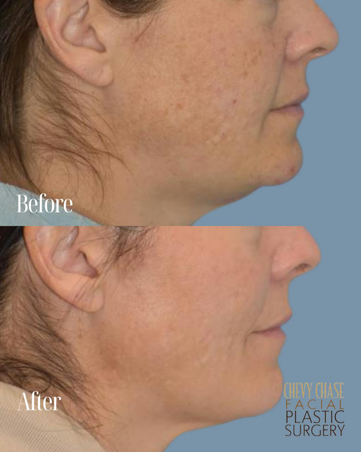 Broadband Light (BBL) Before & After Gallery - Patient 627115 - Image 3