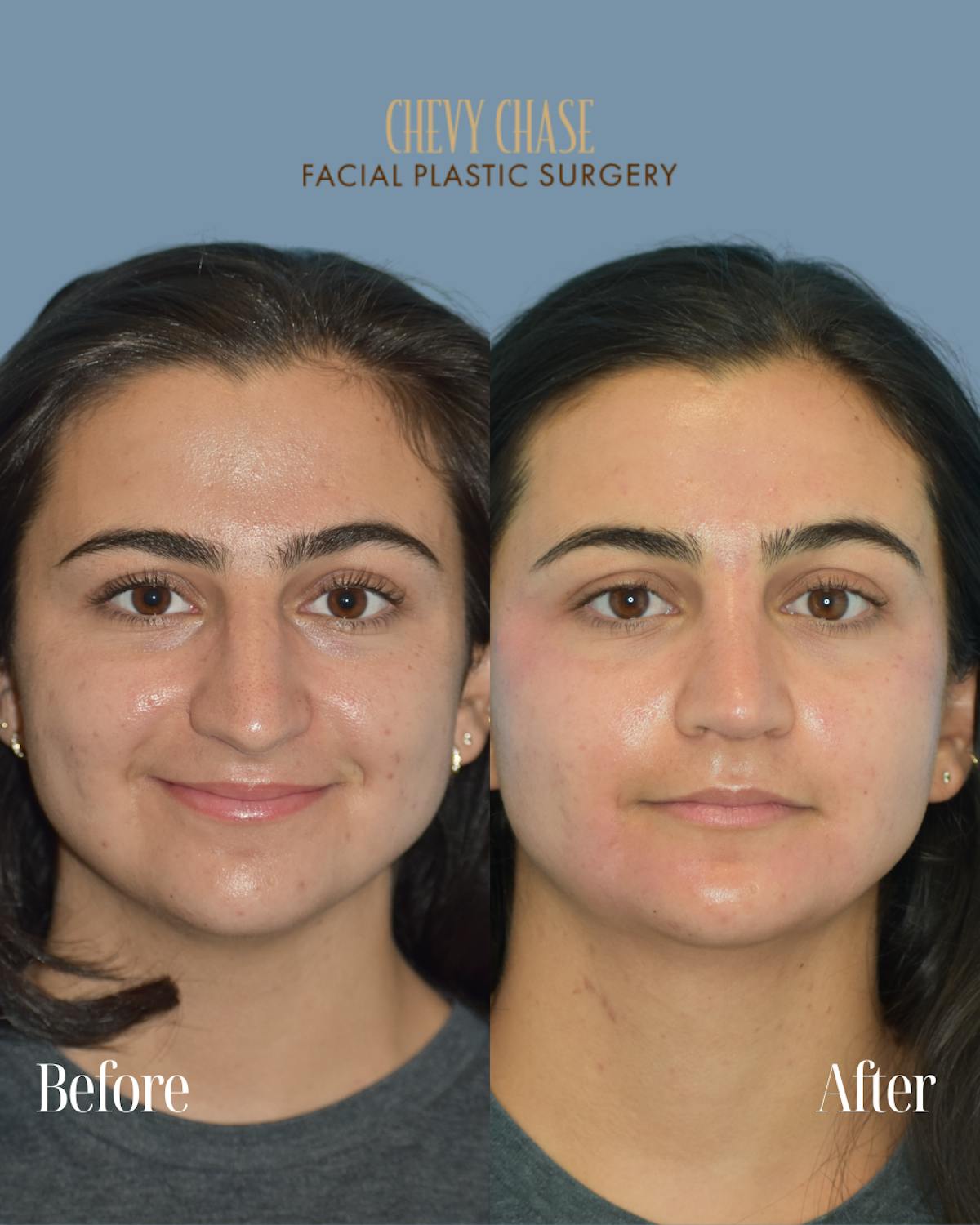Rhinoplasty Before & After Gallery - Patient 154827 - Image 2