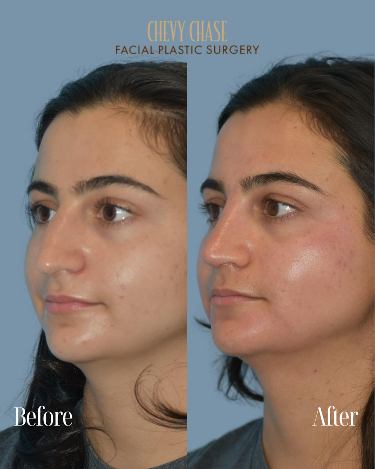 Rhinoplasty Before & After Gallery - Patient 154827 - Image 1