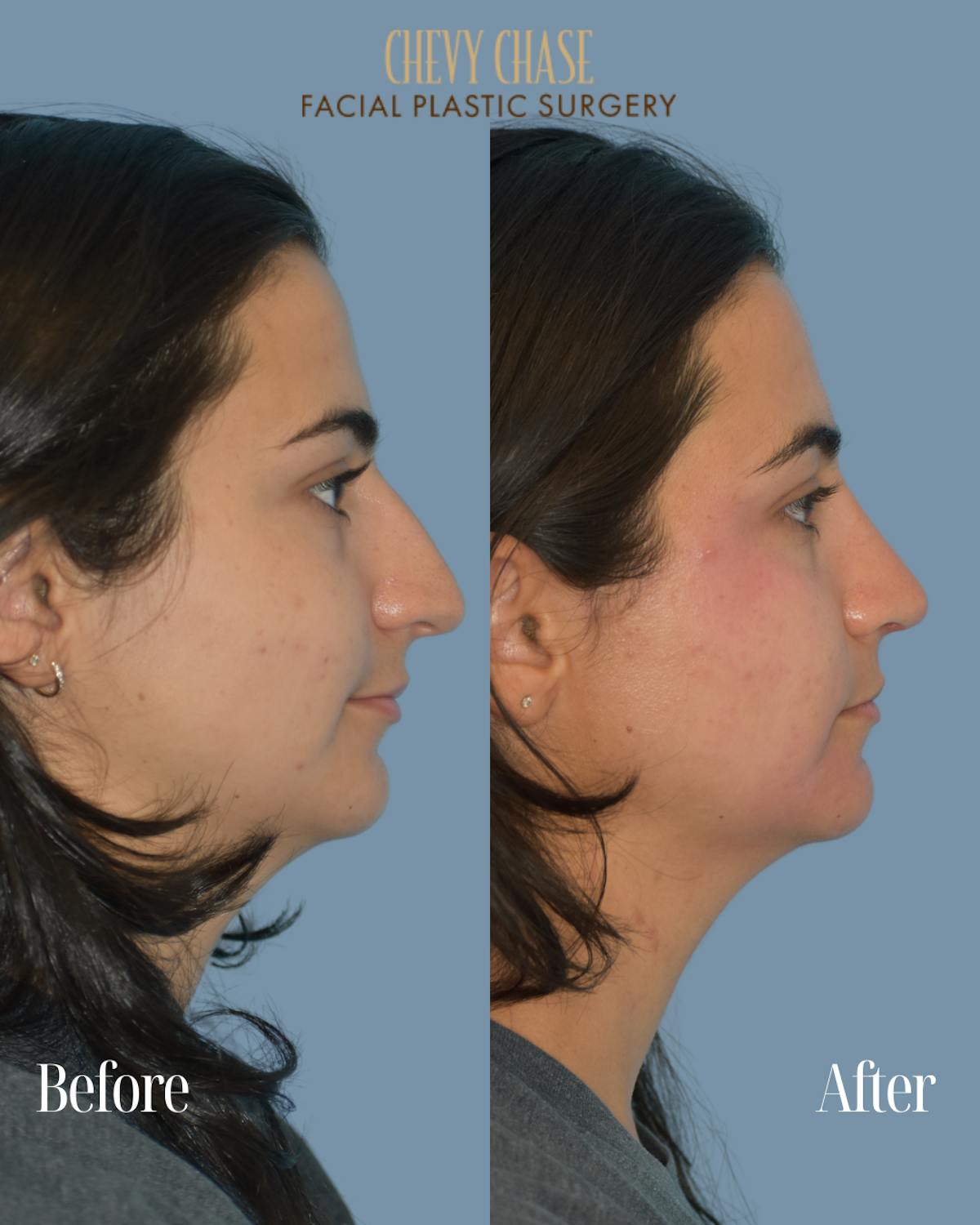 Rhinoplasty Before & After Gallery - Patient 154827 - Image 3