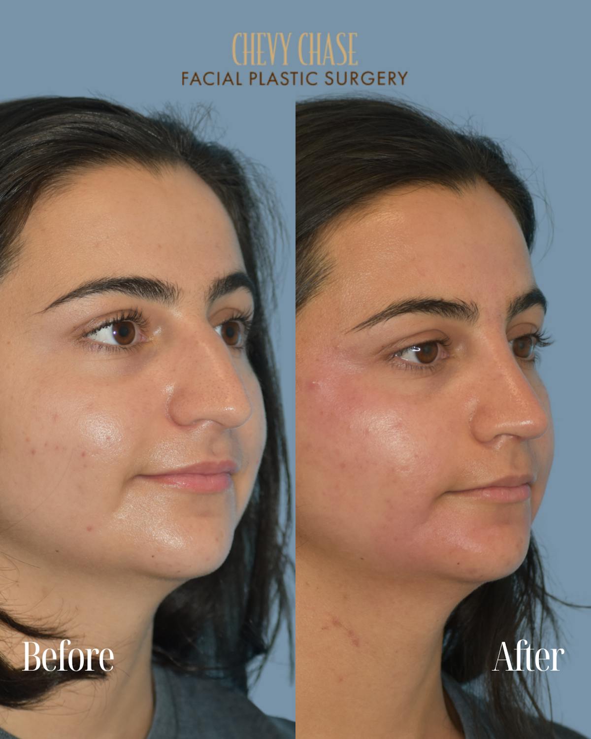 Rhinoplasty Before & After Gallery - Patient 154827 - Image 4