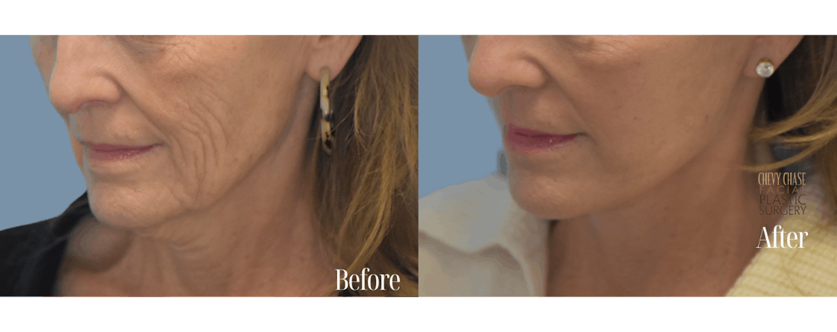 Facelift And Necklift Before & After Gallery - Patient 146581 - Image 5