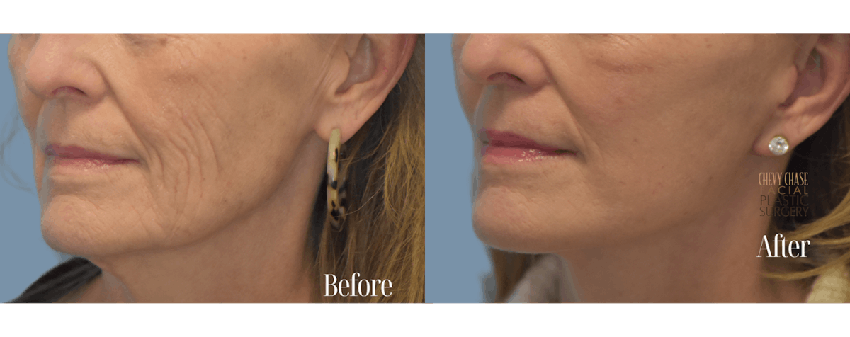 Facelift And Necklift Before & After Gallery - Patient 146581 - Image 6