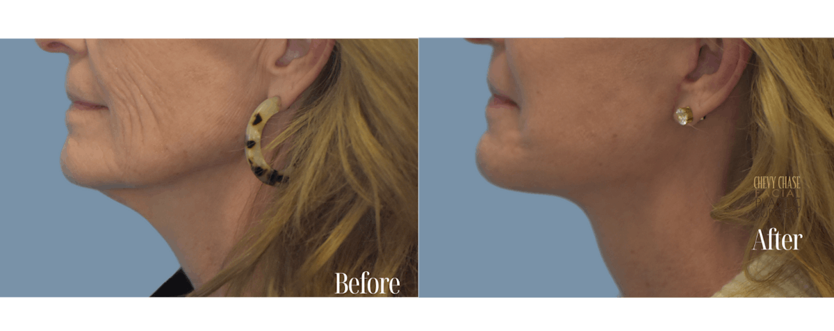 Facelift And Necklift Before & After Gallery - Patient 146581 - Image 4