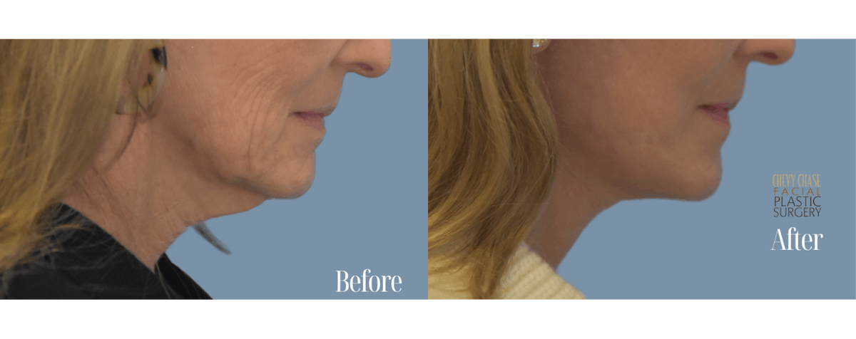 Facelift And Necklift Before & After Gallery - Patient 146581 - Image 1