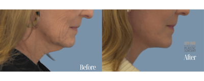 Facelift And Necklift Before & After Gallery - Patient 146581 - Image 1