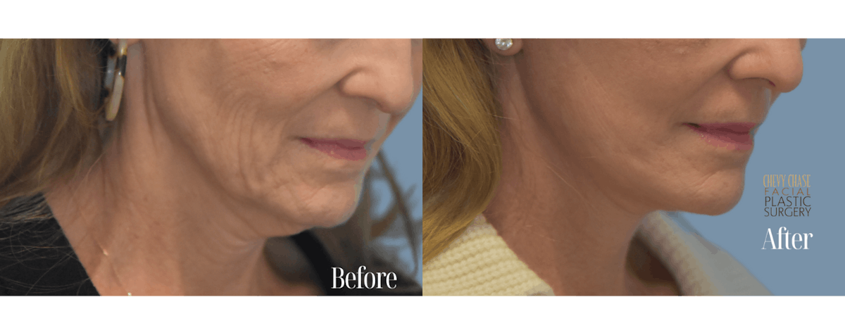 Facelift And Necklift Before & After Gallery - Patient 146581 - Image 2