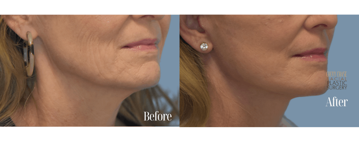 Facelift And Necklift Before & After Gallery - Patient 146581 - Image 3