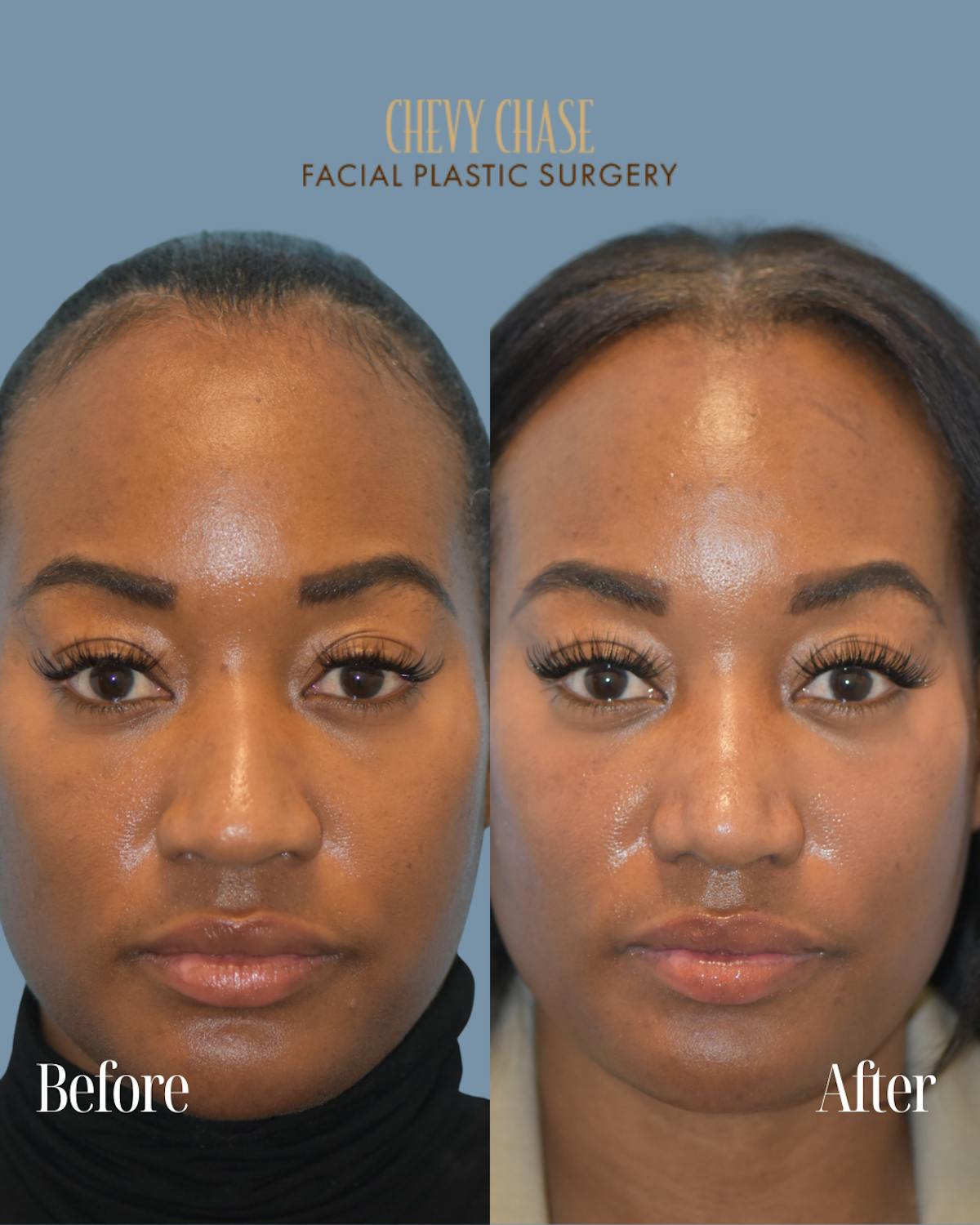Rhinoplasty Before & After Gallery - Patient 253342 - Image 3