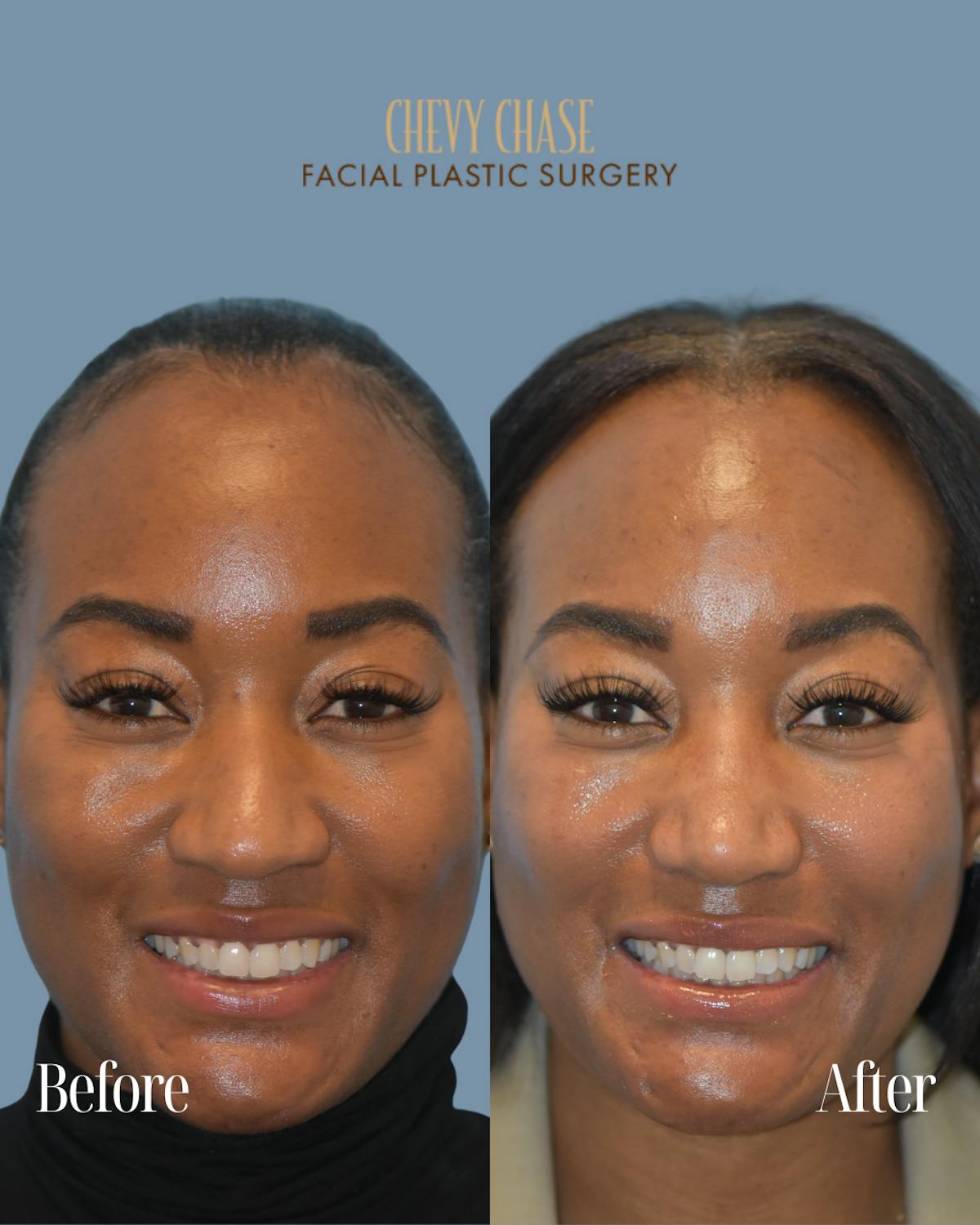Rhinoplasty Before & After Gallery - Patient 253342 - Image 4