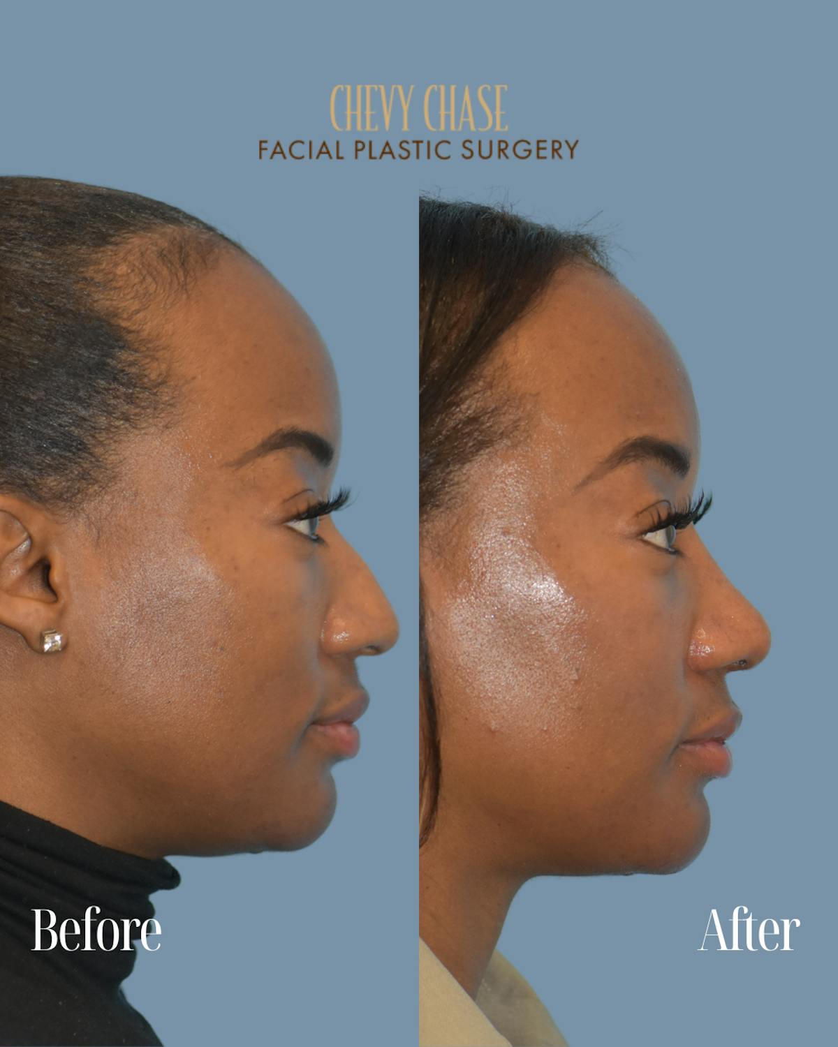 Rhinoplasty Before & After Gallery - Patient 253342 - Image 6