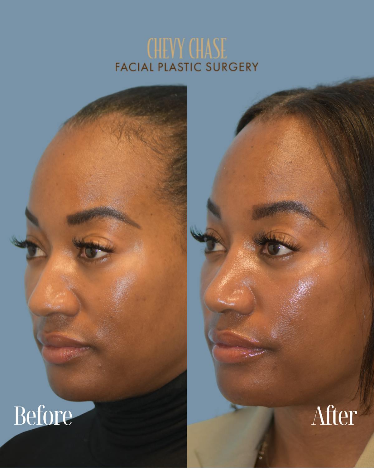 Rhinoplasty Before & After Gallery - Patient 253342 - Image 2