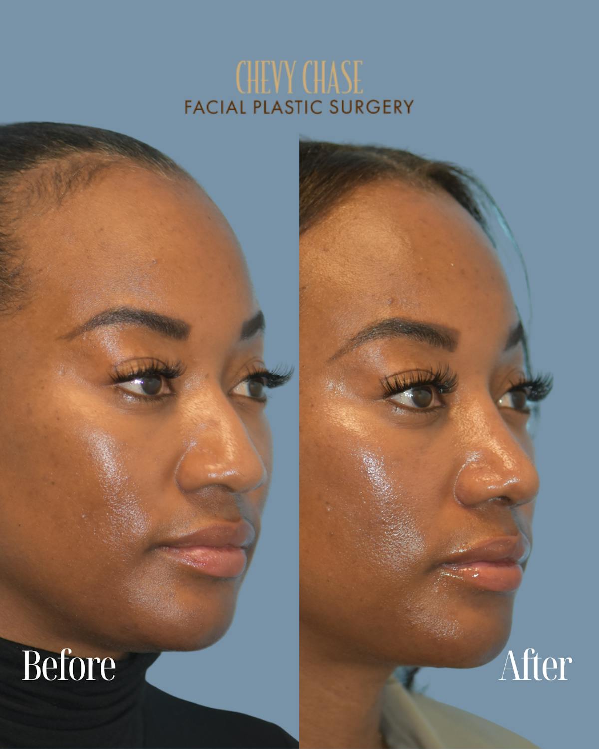 Rhinoplasty Before & After Gallery - Patient 253342 - Image 5