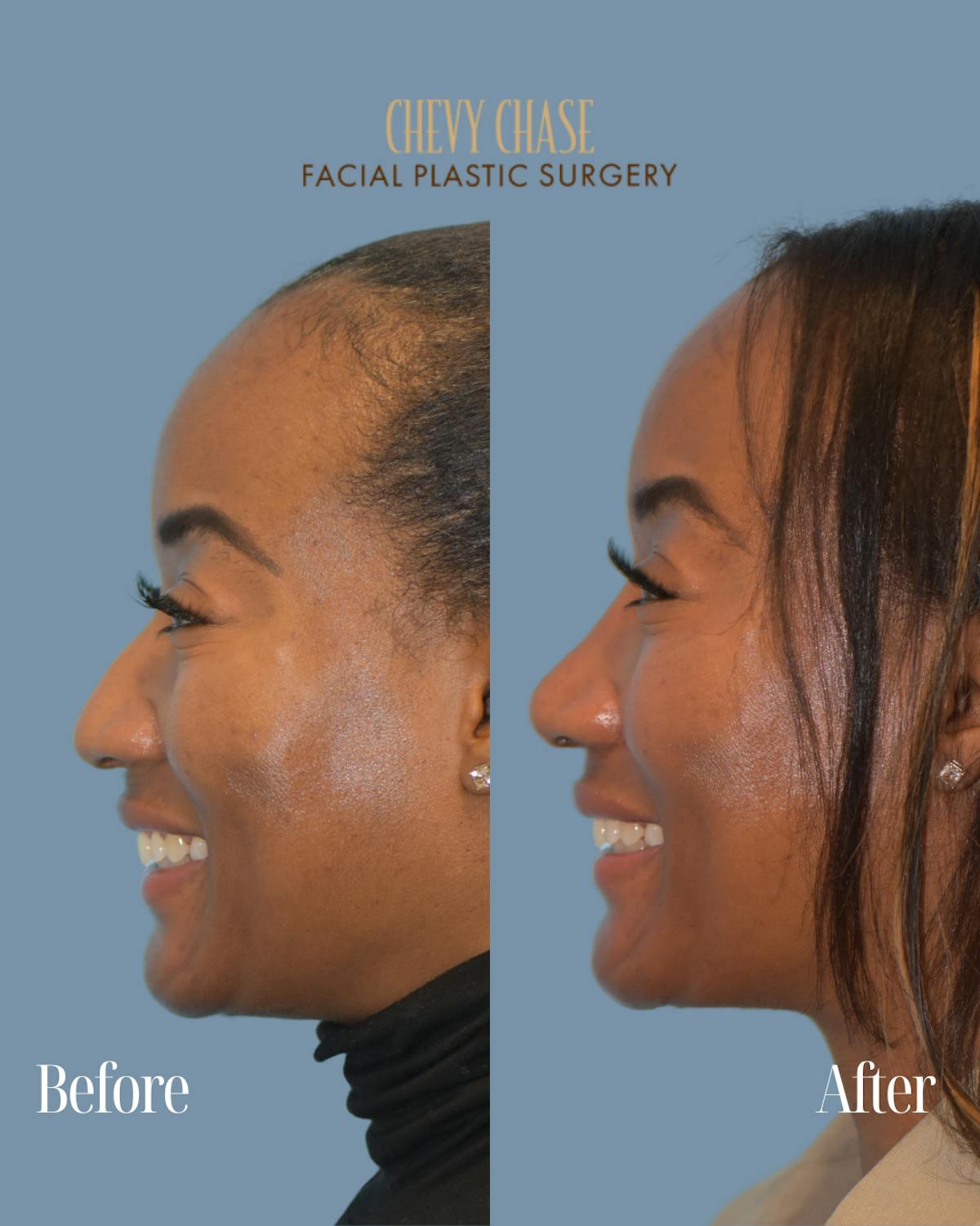 Rhinoplasty Before & After Gallery - Patient 253342 - Image 1
