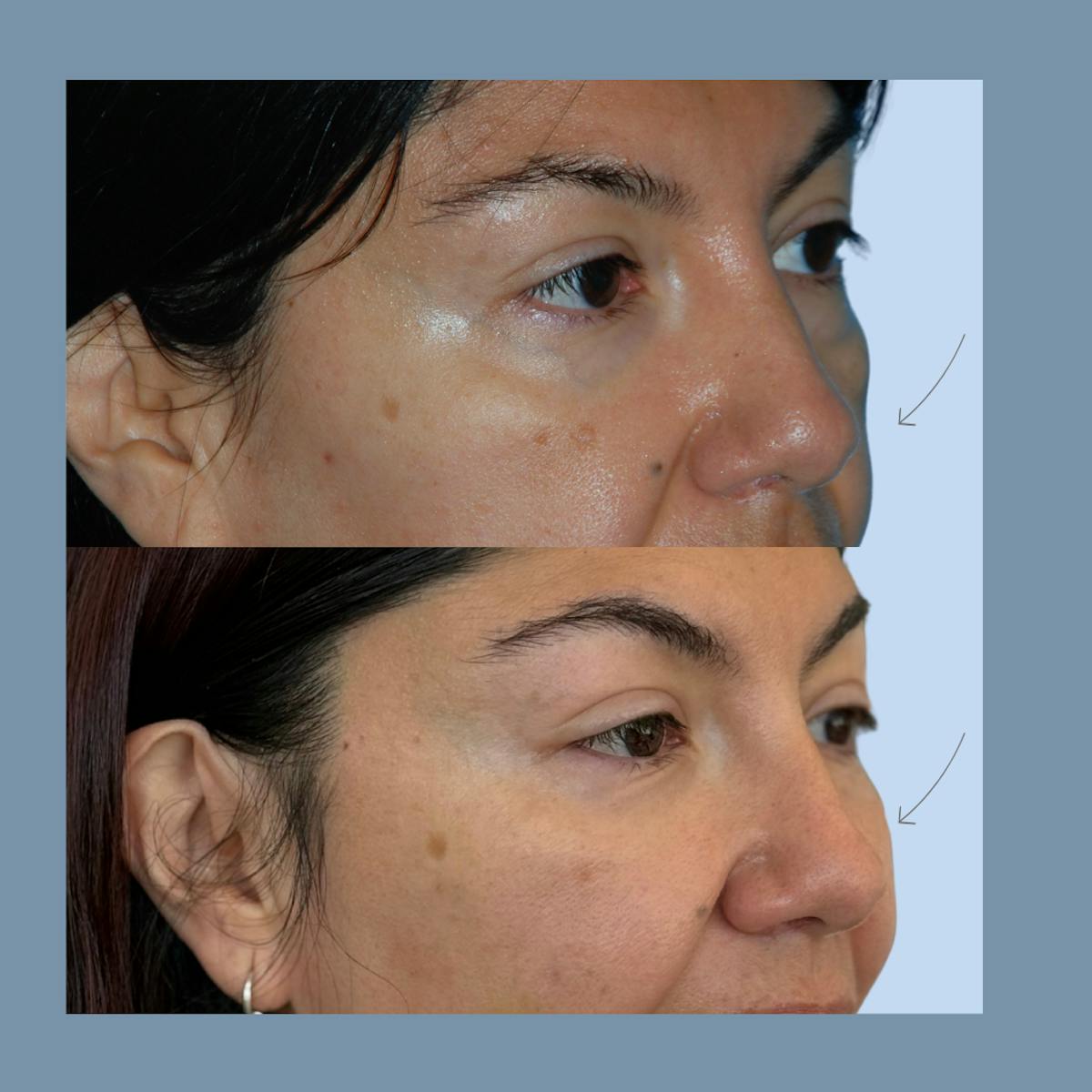 Blepharoplasty Before & After Gallery - Patient 383872 - Image 2