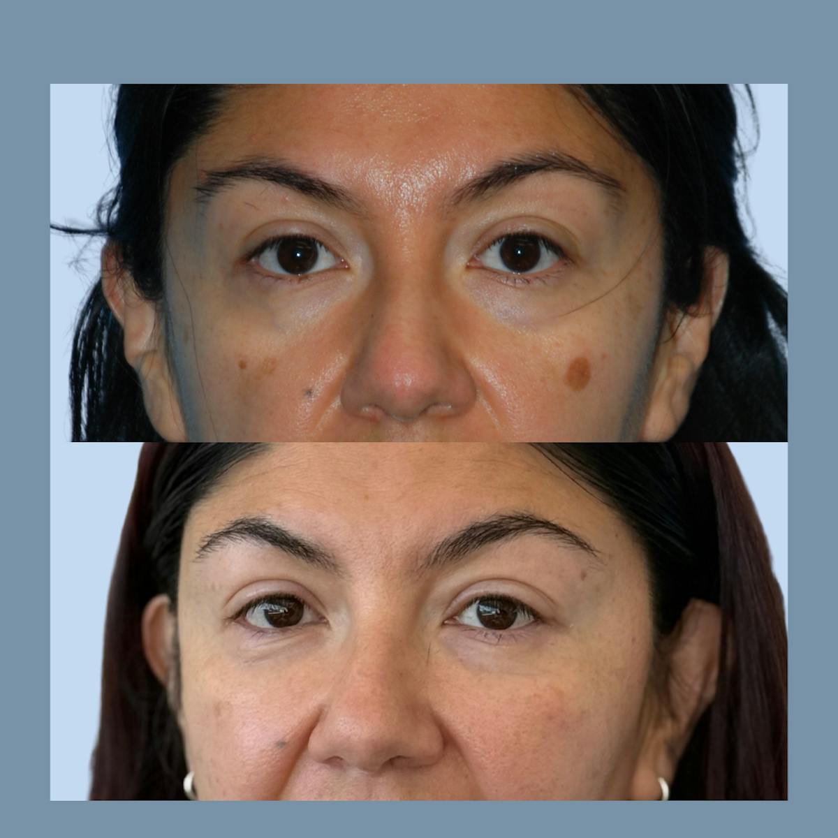 Blepharoplasty Before & After Gallery - Patient 383872 - Image 1