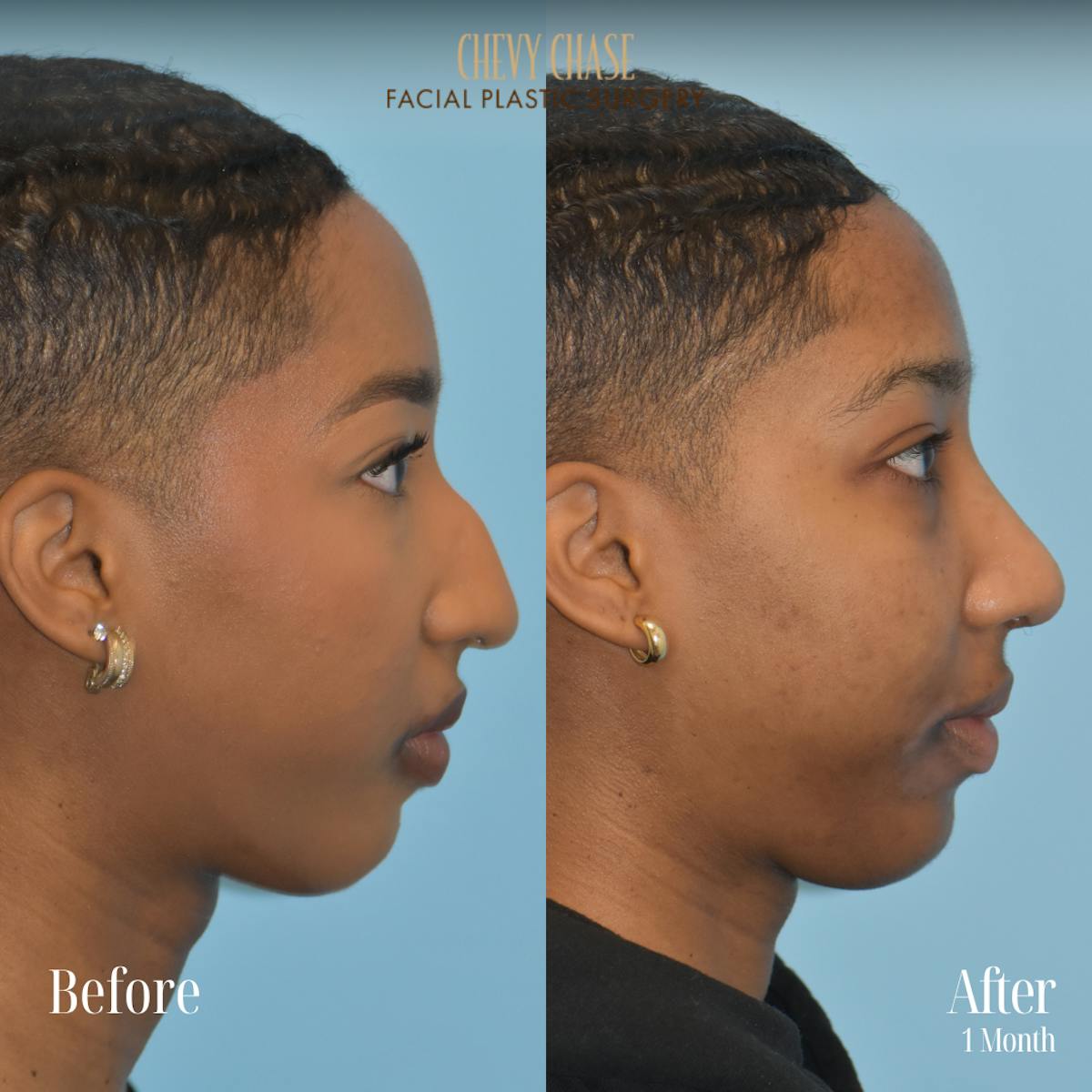Rhinoplasty Before & After Gallery - Patient 176835 - Image 3