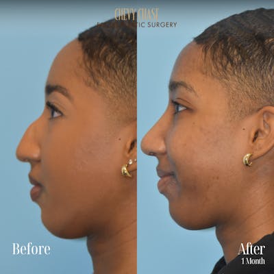 Rhinoplasty Before & After Gallery - Patient 176835 - Image 1