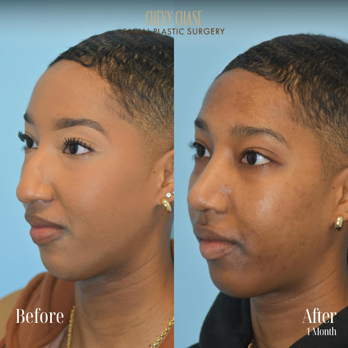 Rhinoplasty Before & After Gallery - Patient 176835 - Image 2