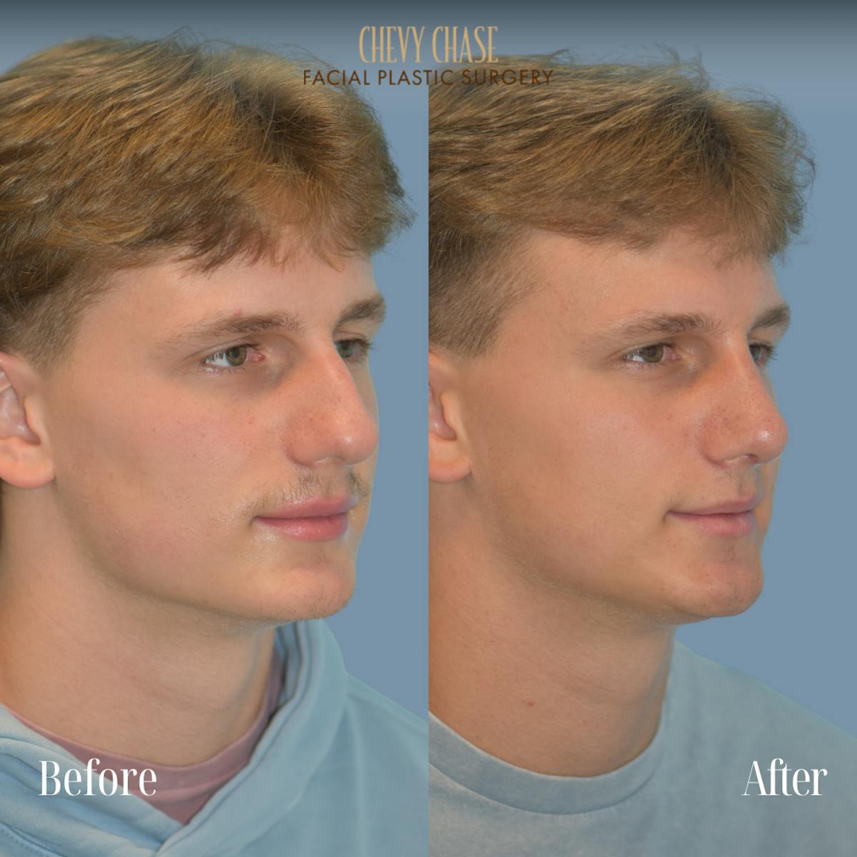 Rhinoplasty Before & After Gallery - Patient 254380 - Image 3