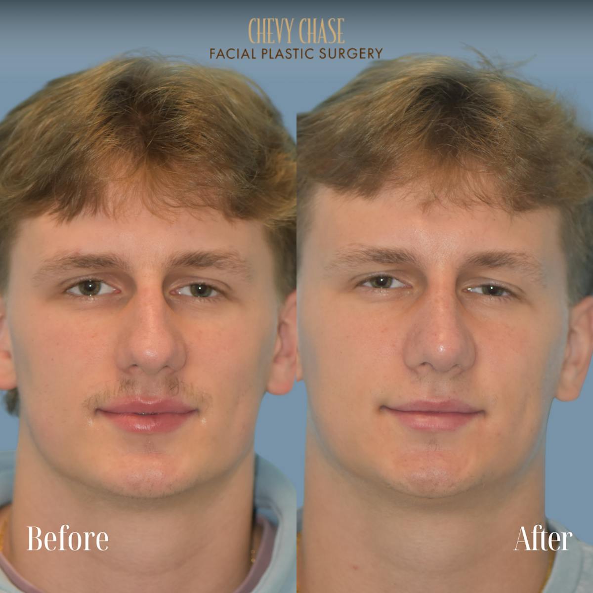 Rhinoplasty Before & After Gallery - Patient 254380 - Image 2