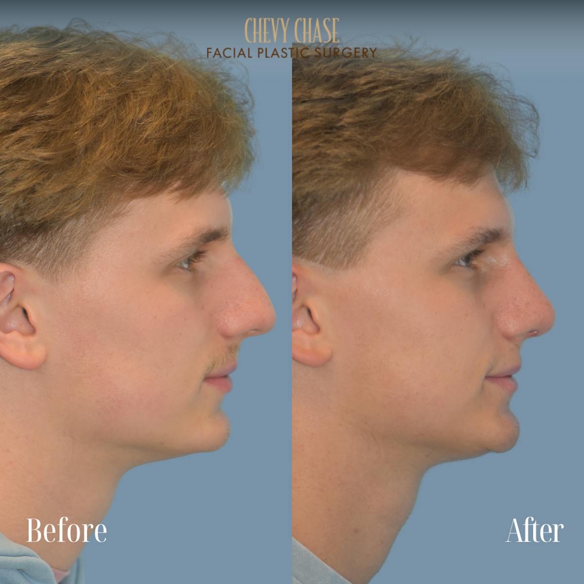 Rhinoplasty Before & After Gallery - Patient 254380 - Image 4