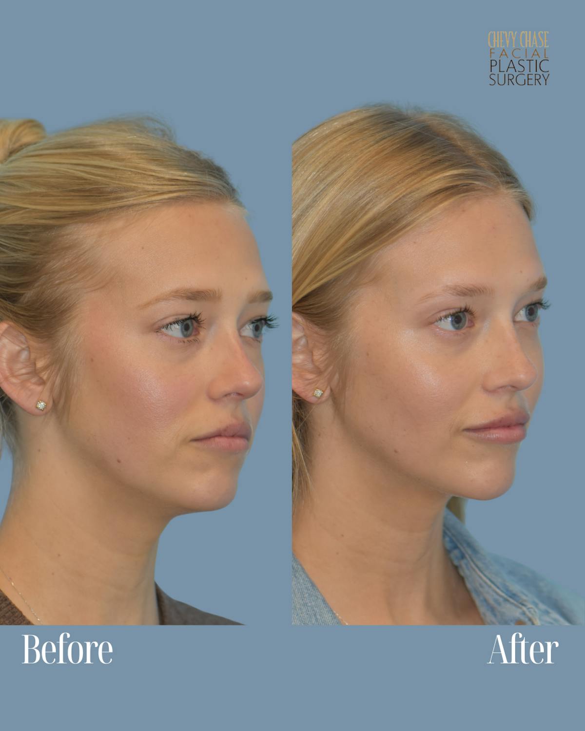 Dermal Fillers Before & After Gallery - Patient 146311 - Image 1