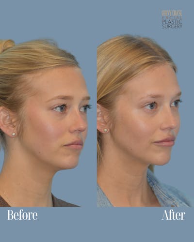 Dermal Fillers Before & After Gallery - Patient 146311 - Image 1
