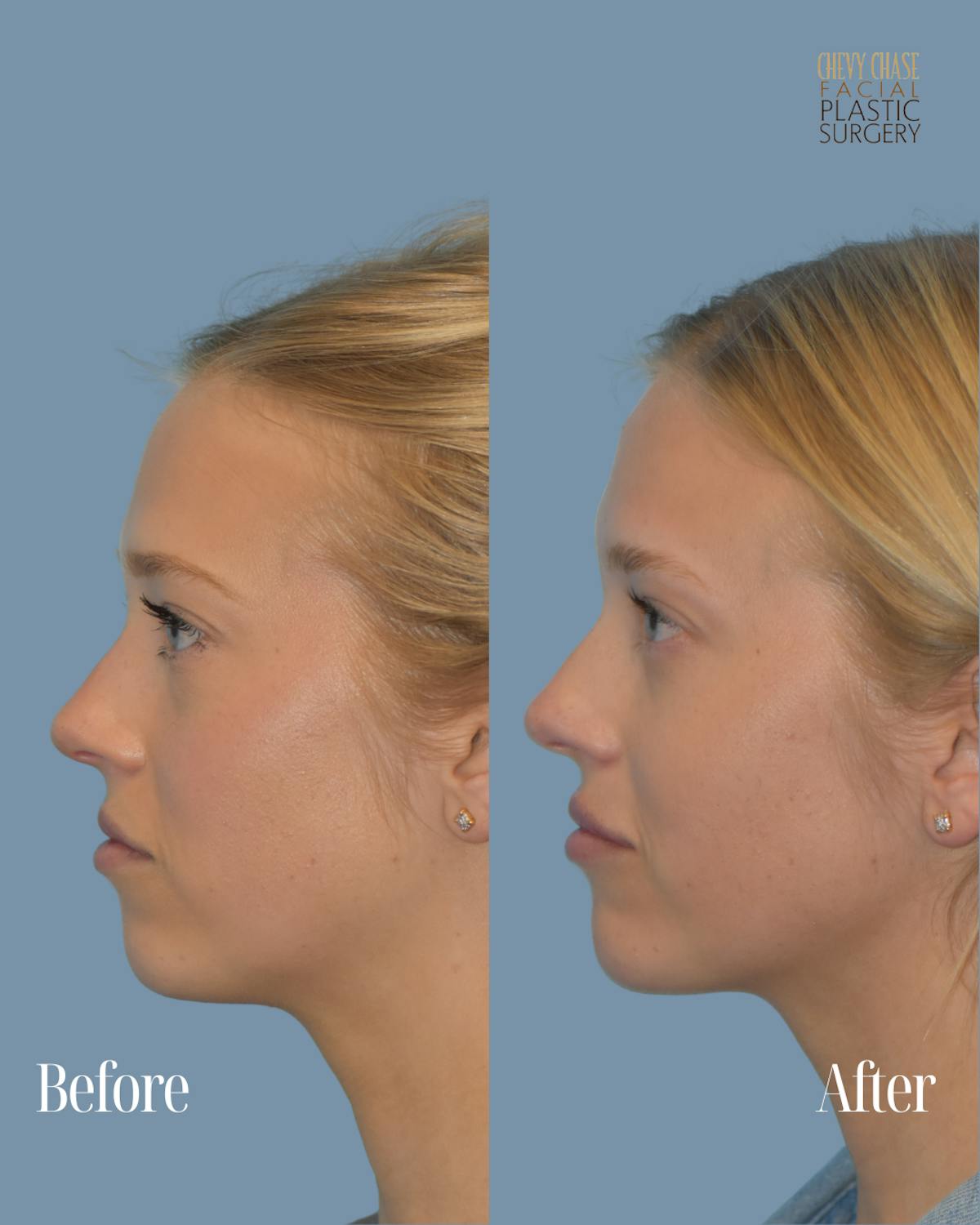 Dermal Fillers Before & After Gallery - Patient 146311 - Image 2