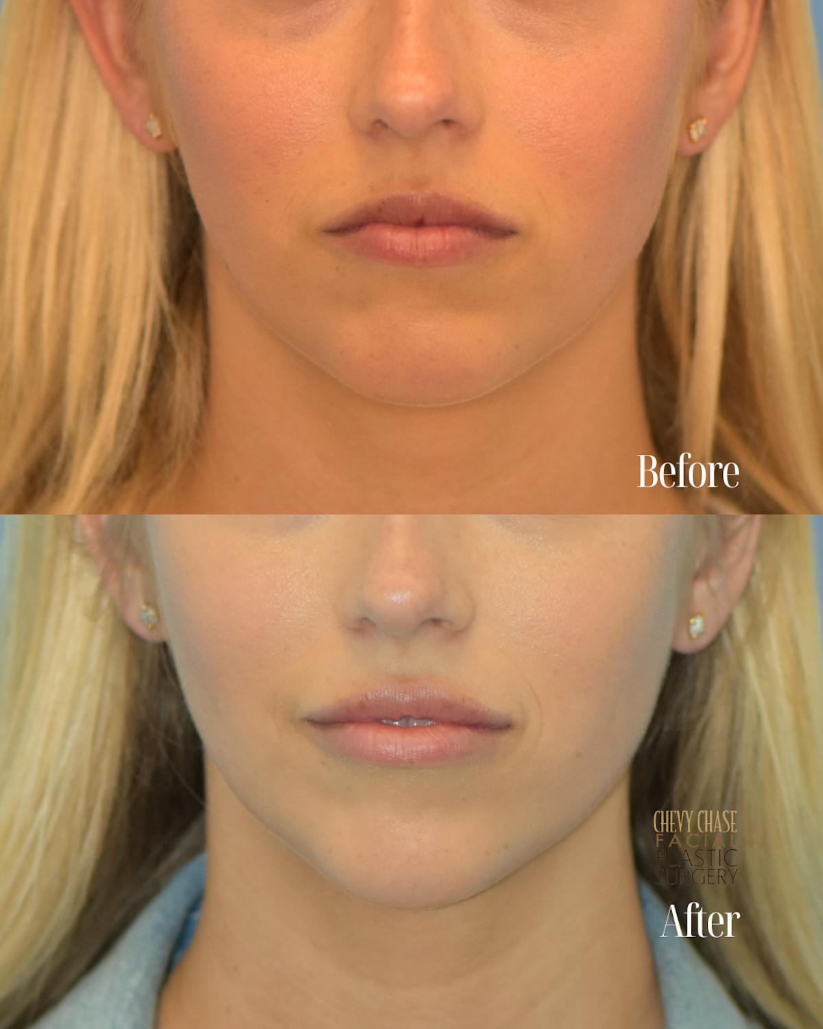 Dermal Fillers Before & After Gallery - Patient 317894 - Image 1