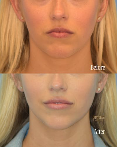 Dermal Fillers Before & After Gallery - Patient 317894 - Image 1