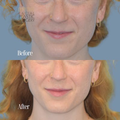 Dermal Fillers Before & After Gallery - Patient 219085 - Image 1