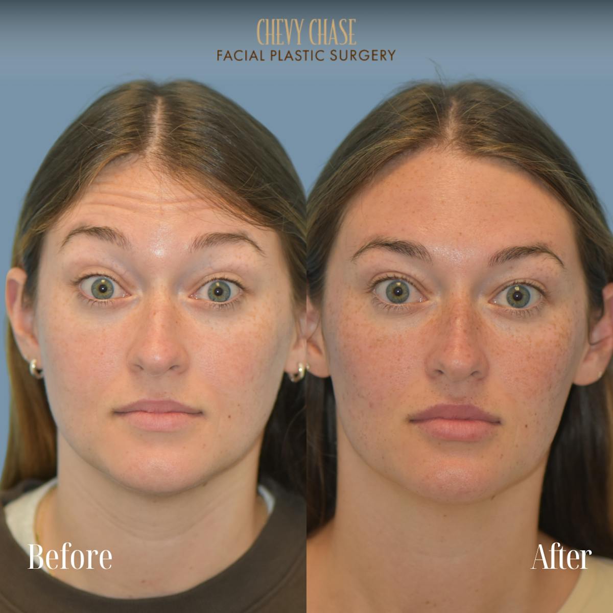 Botox® / Wrinkle Treatments Before & After Gallery - Patient 165376 - Image 3