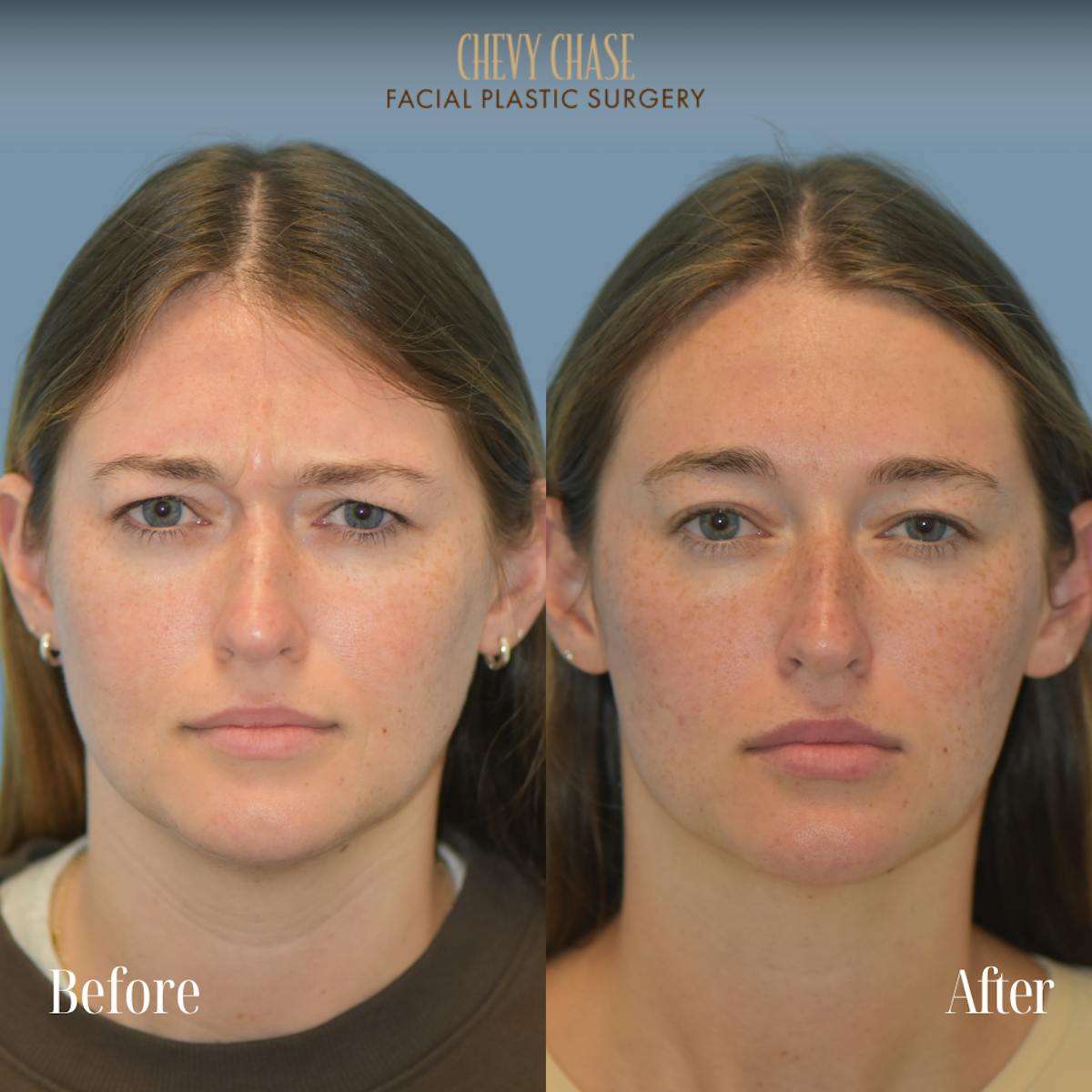 Botox® / Wrinkle Treatments Before & After Gallery - Patient 165376 - Image 2