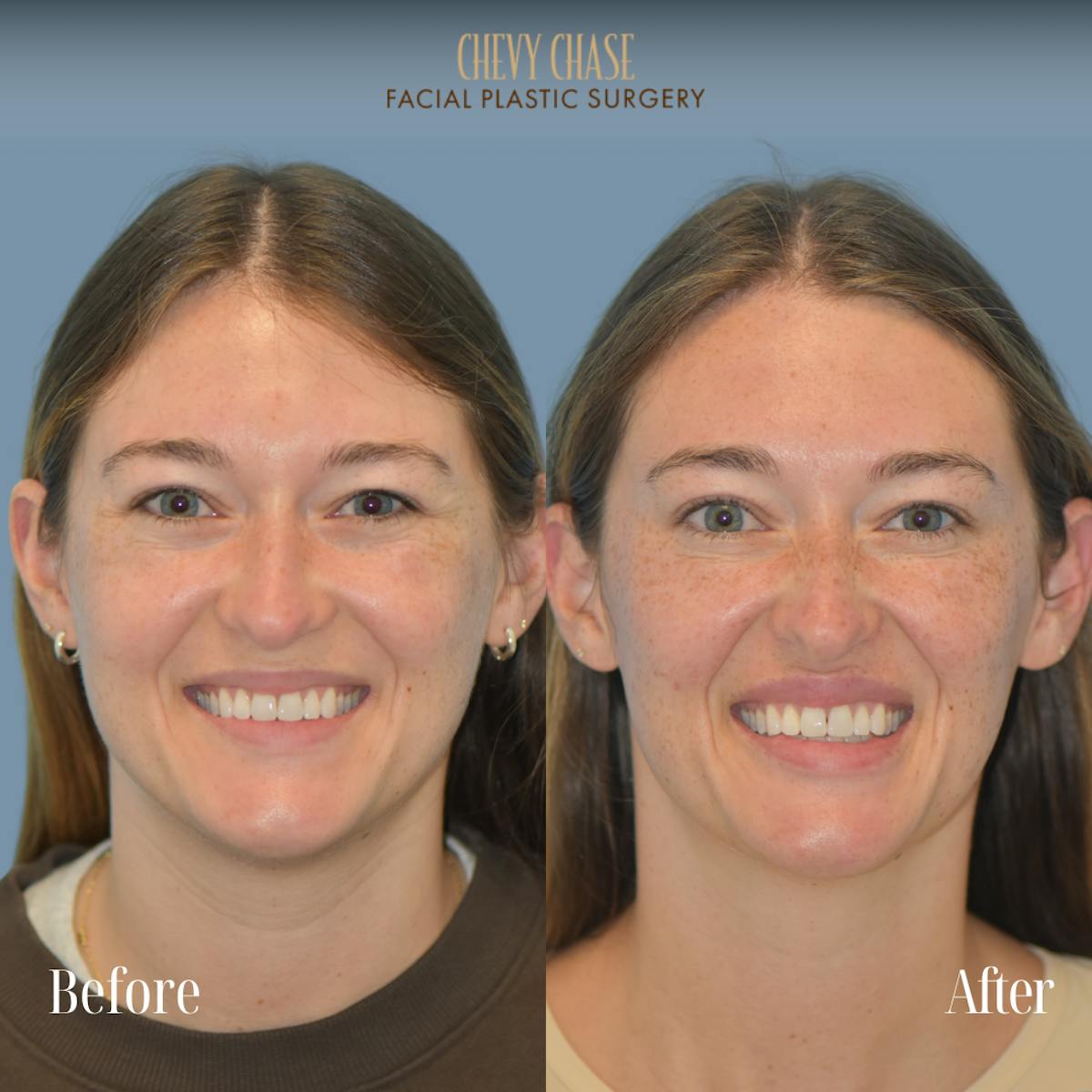 Botox® / Wrinkle Treatments Before & After Gallery - Patient 165376 - Image 1