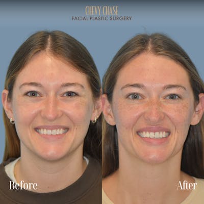 Botox® / Wrinkle Treatments Before & After Gallery - Patient 165376 - Image 1