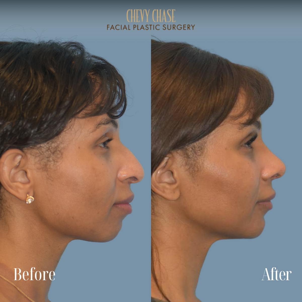 Chin Implant Before & After Gallery - Patient 380479 - Image 6