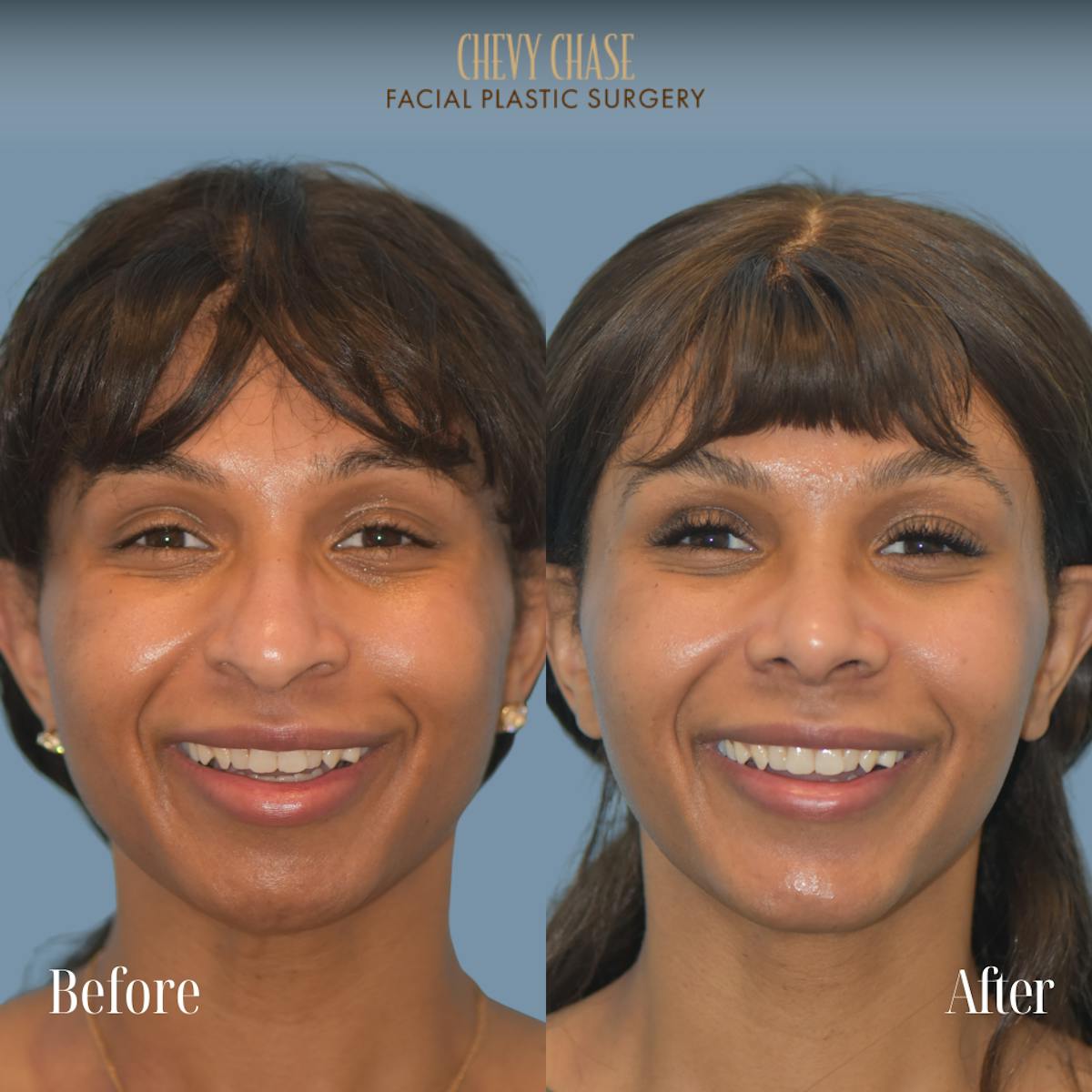 Chin Implant Before & After Gallery - Patient 380479 - Image 4