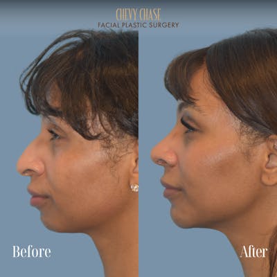 Chin Implant Before & After Gallery - Patient 380479 - Image 1