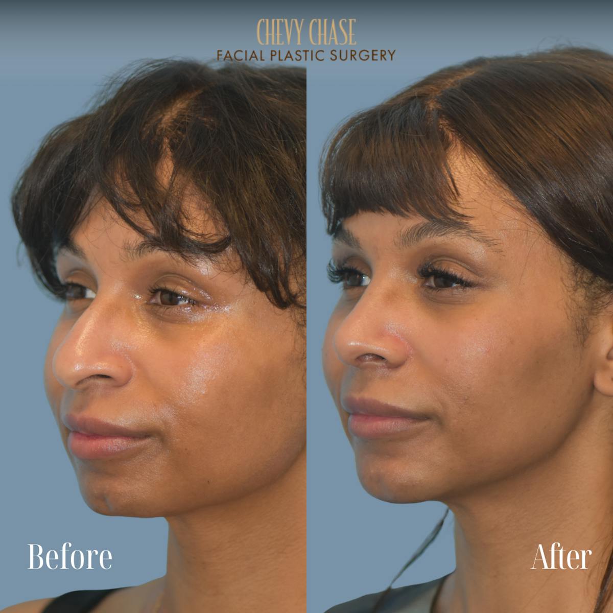 Chin Implant Before & After Gallery - Patient 380479 - Image 3
