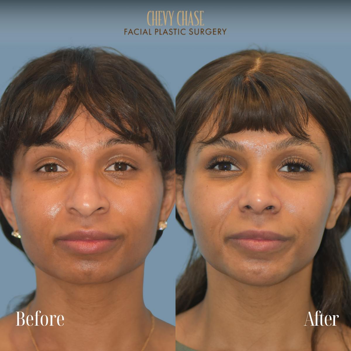 Chin Implant Before & After Gallery - Patient 380479 - Image 5