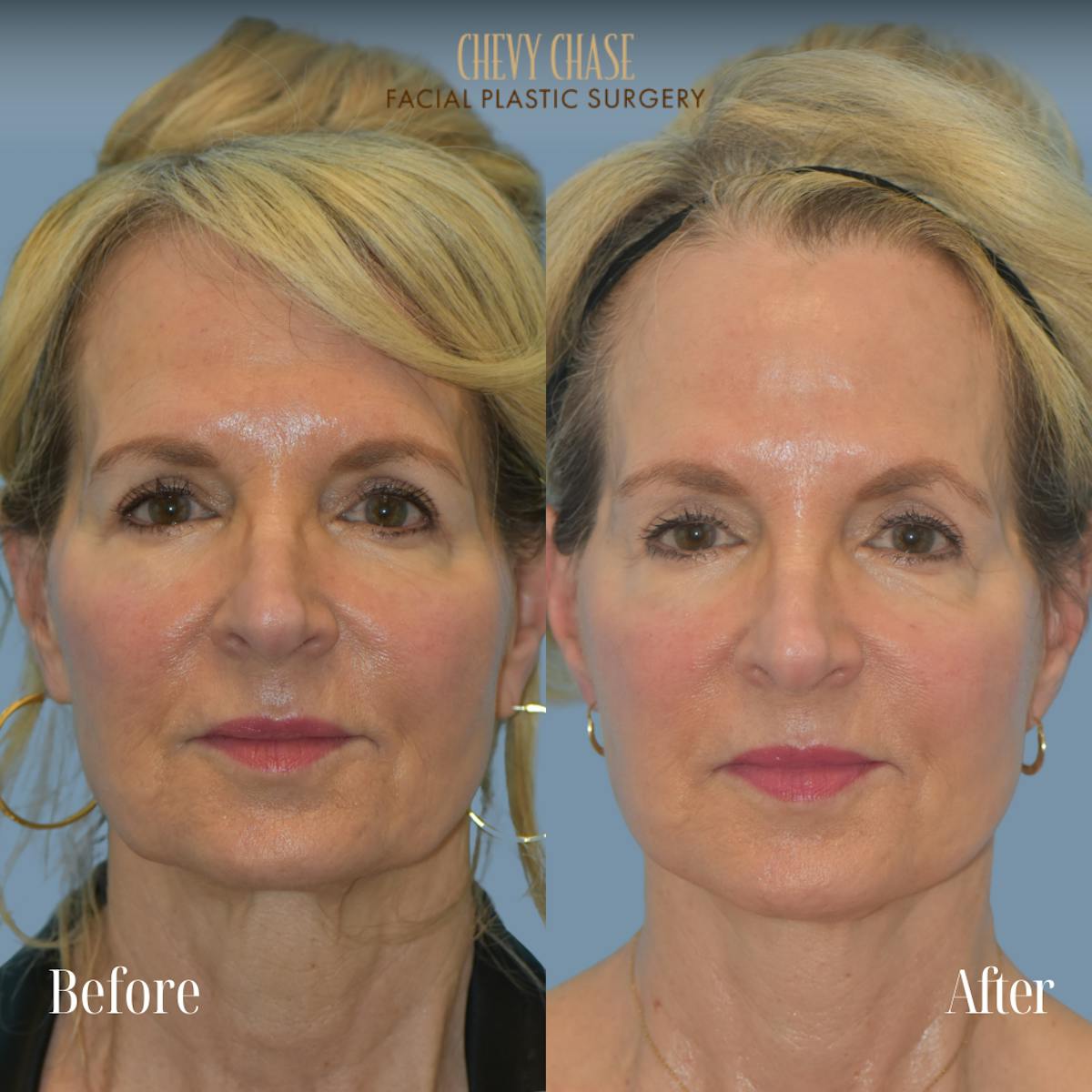 Facelift And Necklift Before & After Gallery - Patient 281702 - Image 6