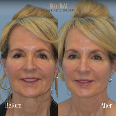 Facelift And Necklift Before & After Gallery - Patient 281702 - Image 1