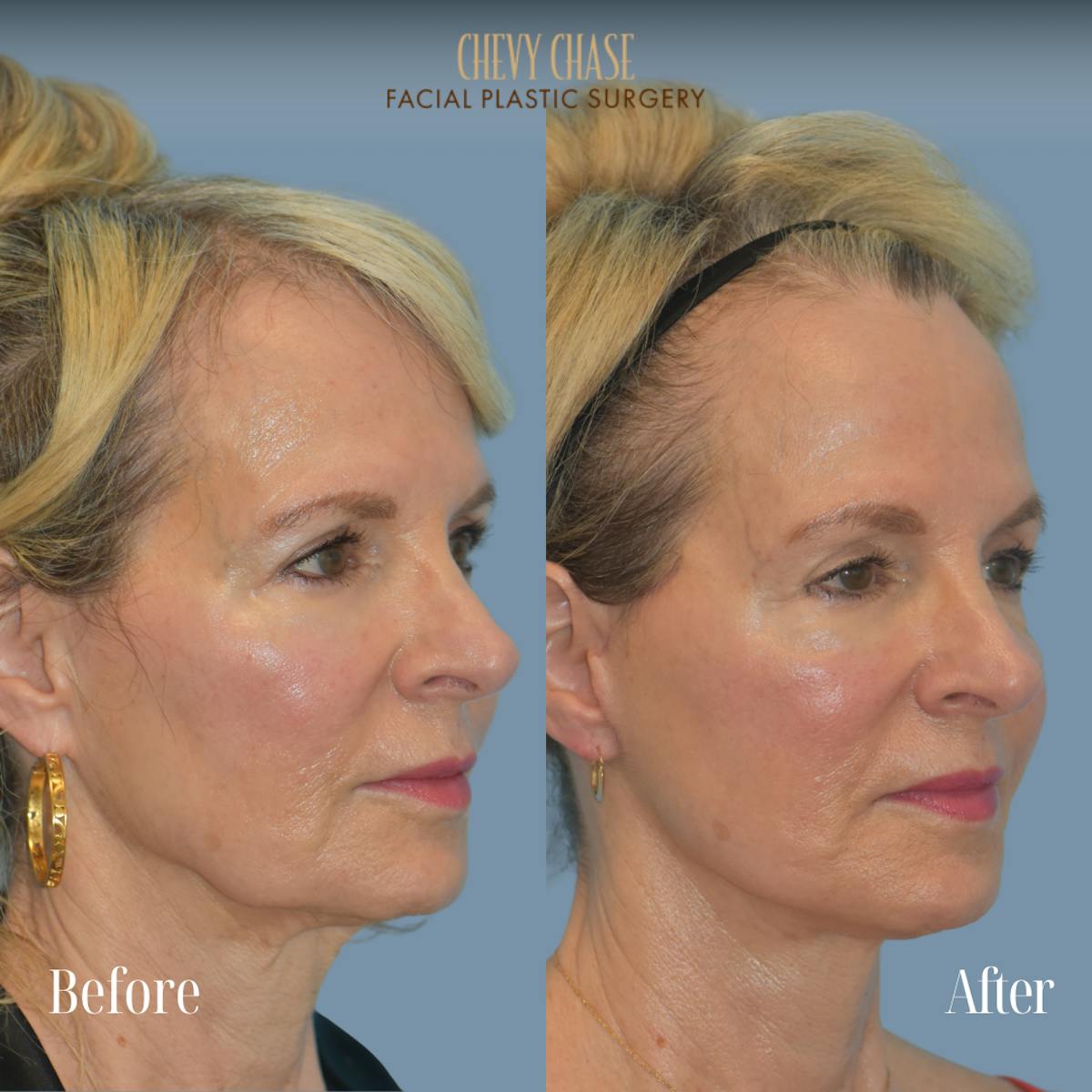Facelift And Necklift Before & After Gallery - Patient 281702 - Image 2