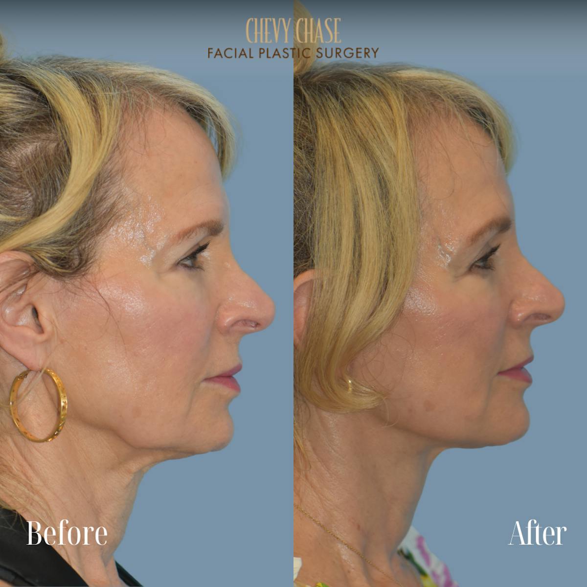 Facelift And Necklift Before & After Gallery - Patient 281702 - Image 3