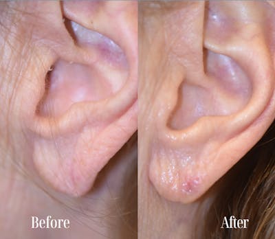 Earlobe Repair Before & After Gallery - Patient 287888 - Image 1
