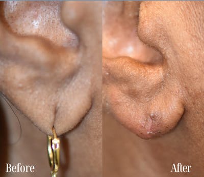 Earlobe Repair Before & After Gallery - Patient 175269 - Image 1