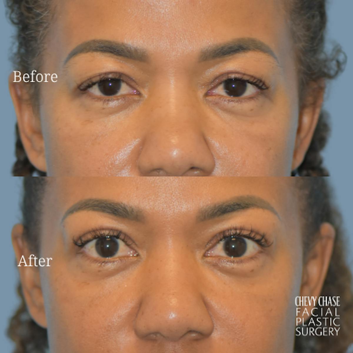 Blepharoplasty Before & After Gallery - Patient 404607 - Image 1
